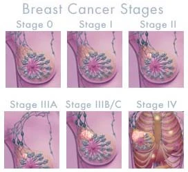 Τα στάδια του καρκίνου του μαστού