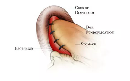 Πρόσθια ημιθολοπλαστική Dorr μετά από καρδιομυοτομή