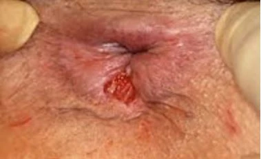 Chronic anal fissure